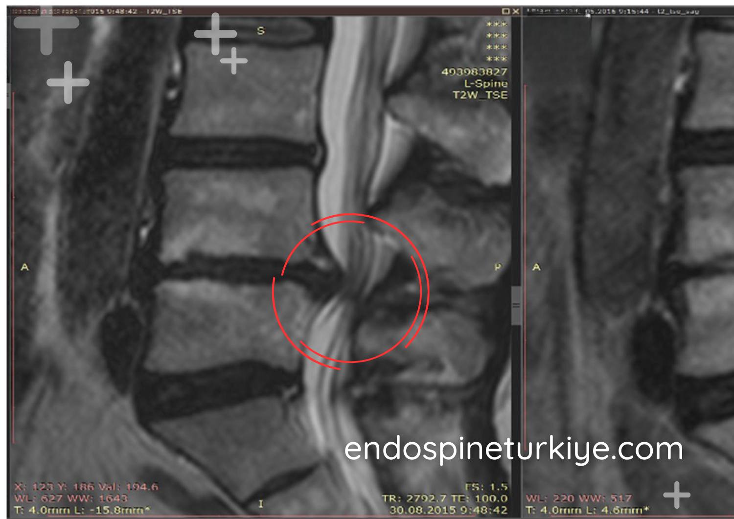 Bel fıtığı tedavi öncesi MR görüntüsü - L4-L5 disk hernisi