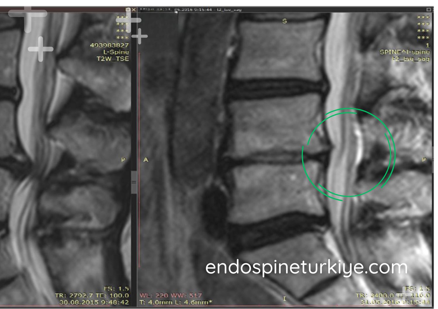 Lazerle bel fıtığı tedavisi sonrası MR görüntüsü - PLDD sonucu