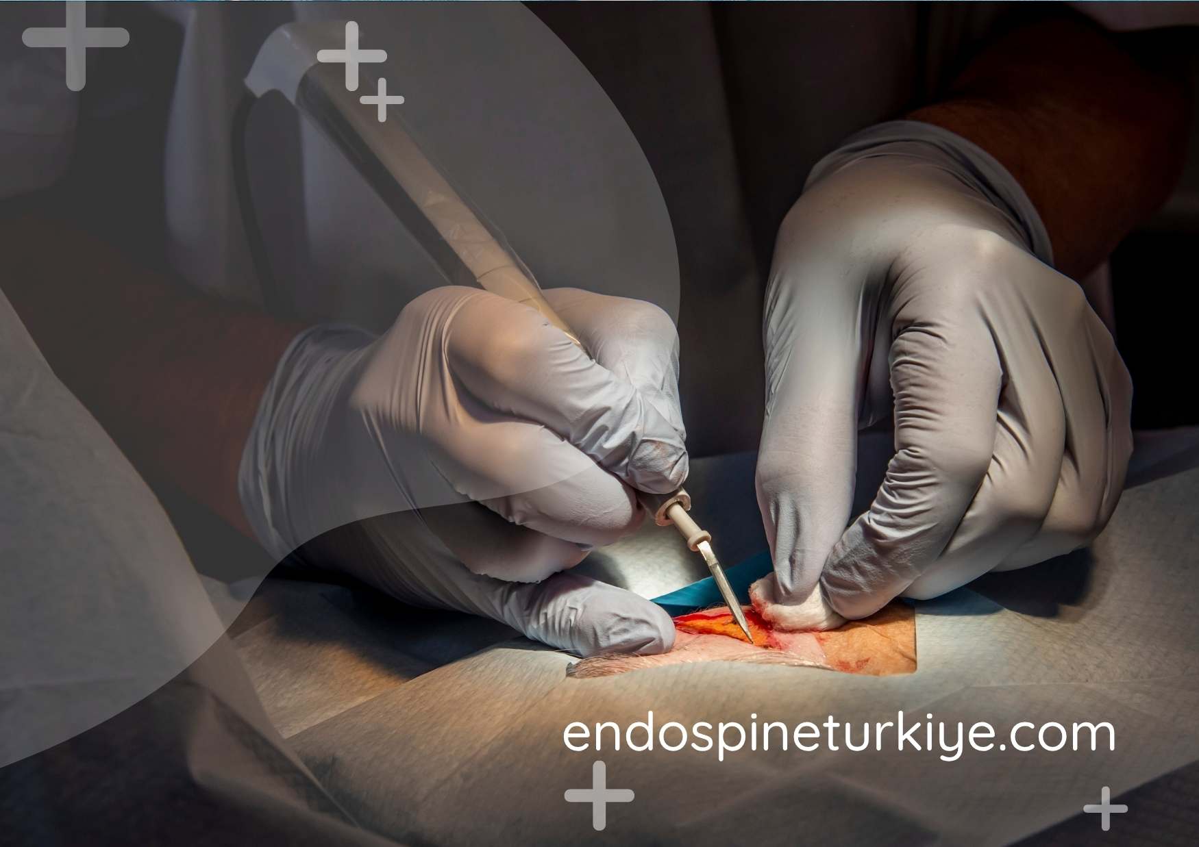 Kapalı Yöntemle Fıtık Cerrahisi - Endoskopik ve Mikroskobik