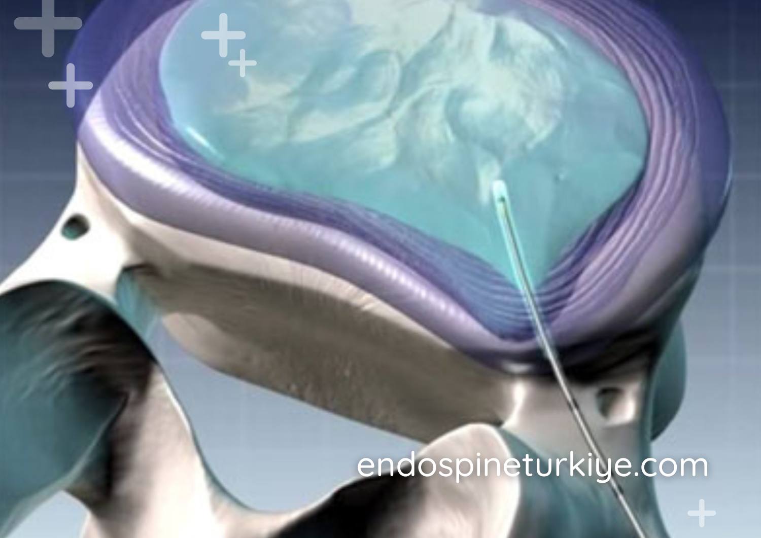 Lazerle bel fıtığı tedavisi PLDD işlemi - Minimal invaziv lazer teknolojisi