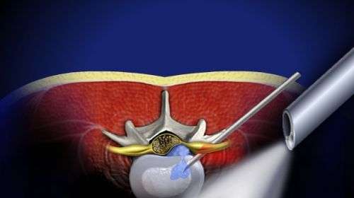 Bel Fıtığı Tedavisinde Yeni Çağ: Tam Kapalı Endoskopik Cerrahi